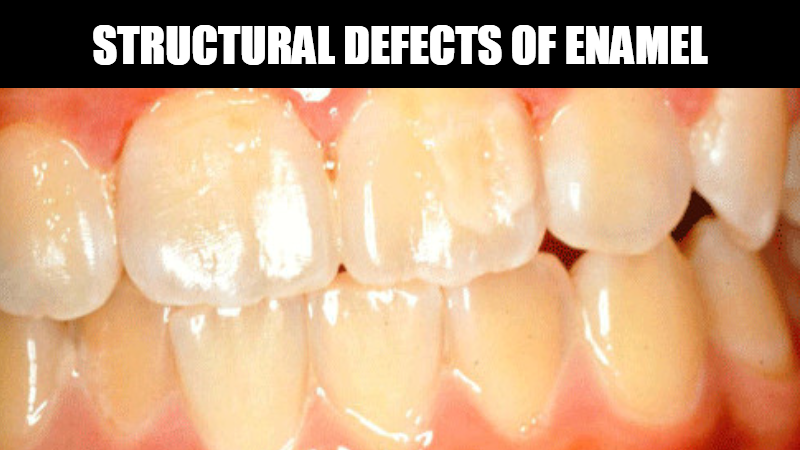 Structural Defects Of Enamel